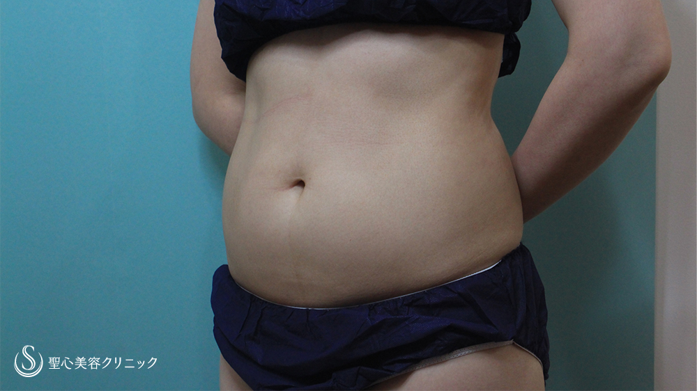 【30代女性・続けて脂肪にダメージを与えることで効果をより実感】クリスタル、リポセル（2か月後） Before 