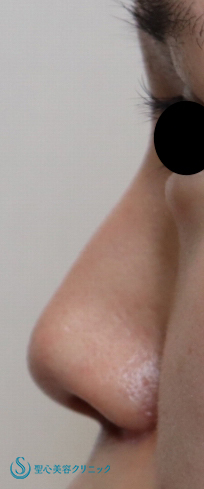 【20代女性・鼻先をシャープに】鼻尖縮小（団子鼻縮小）+鼻尖形成（耳介軟骨移植）（1か月後） Before 