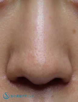 【20代女性・鼻先をシャープに】鼻尖縮小（団子鼻縮小）+鼻尖形成（耳介軟骨移植）（1か月後） Before 