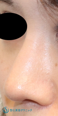 【20代女性・鼻先をシャープに】鼻尖縮小（団子鼻縮小）+鼻尖形成（耳介軟骨移植）（1か月後） After 