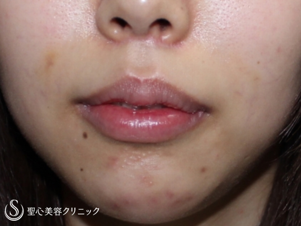 【20代女性・M字リップ、下唇を薄く】M字リップ（1ヶ月後） After 