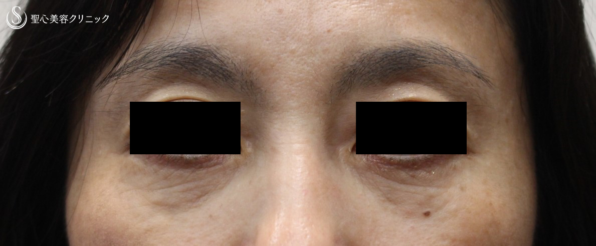 【50代女性：目の下のくま】プレミアムPRP皮膚再生療法（１年半後） Before 