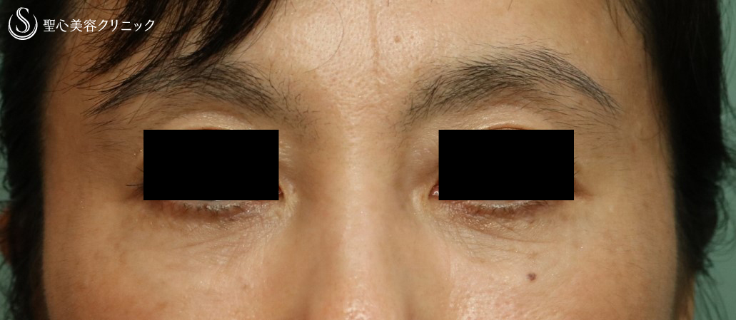 【50代女性：目の下のくま】プレミアムPRP皮膚再生療法（１年半後） After 