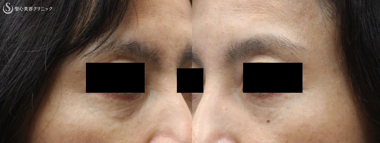 【50代女性：目の下のくま】プレミアムPRP皮膚再生療法（１年半後） Before 