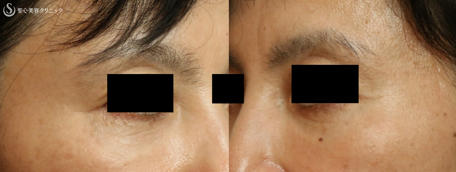 【50代女性：目の下のくま】プレミアムPRP皮膚再生療法（１年半後） After 