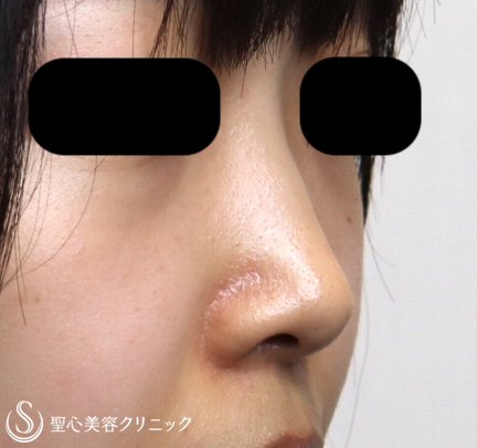 代女性 Gメッシュで鼻を綺麗に高く Gメッシュ 施術直後 症例写真 美容整形 美容外科なら聖心美容クリニック 代女性 Gメッシュで鼻を綺麗に高く Gメッシュ 施術直後 症例写真 美容整形 美容外科なら聖心美容クリニック