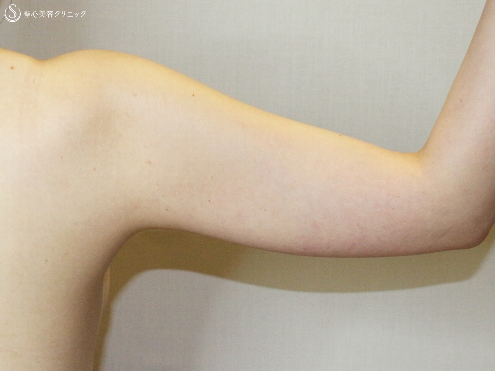 【20代女性・二の腕を綺麗に細く】ベイザー脂肪吸引（2ヶ月後） Before 