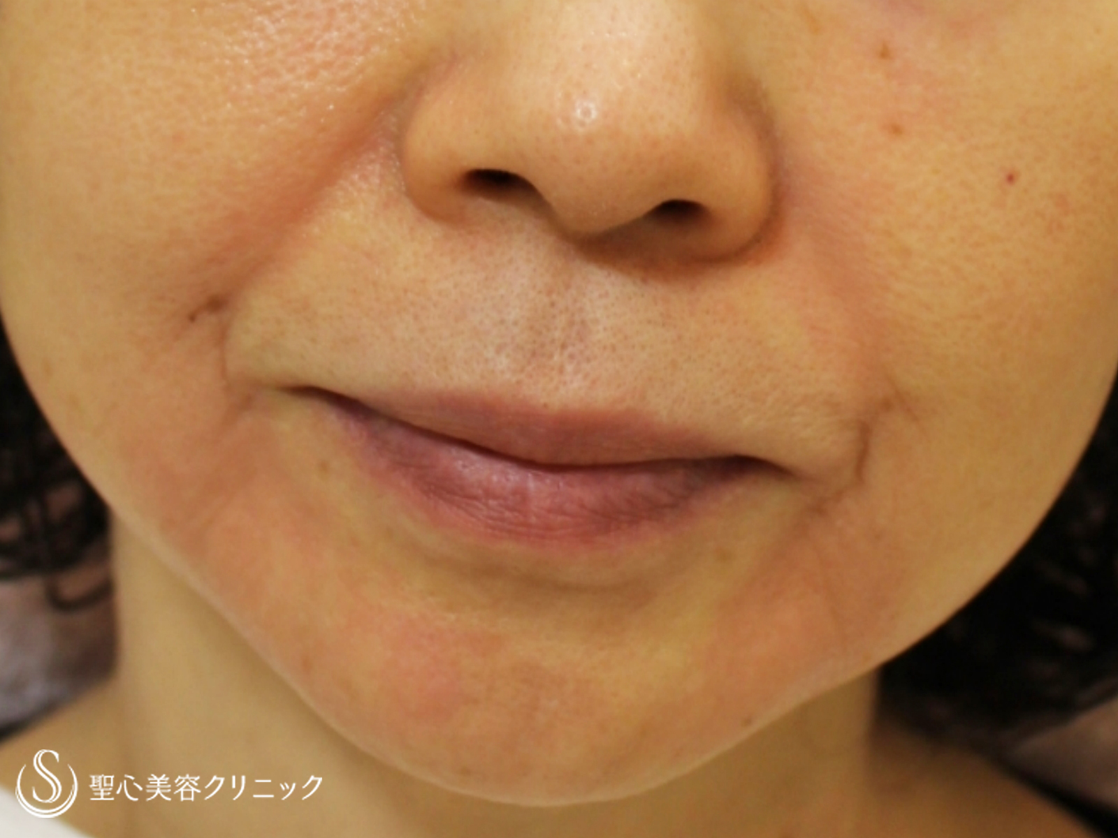 【60代女性・ほうれい線の長期経過】プレミアムPRP皮膚再生療法（7年後） Before 