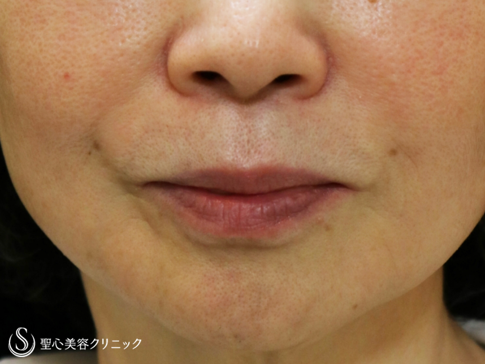 【60代女性・ほうれい線の長期経過】プレミアムPRP皮膚再生療法（7年後） After 