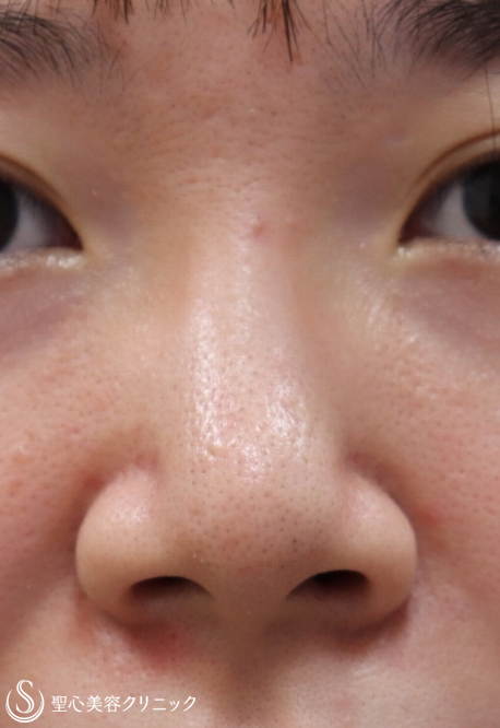 【20代女性・小鼻の広がりを小さく＋自然に鼻筋を通す】鼻プロテーゼ＋小鼻縮小（1ヶ月後） Before 