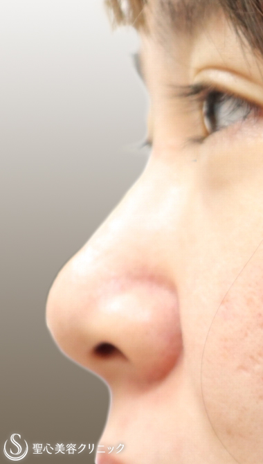 【20代女性・小鼻の広がりを小さく＋自然に鼻筋を通す】鼻プロテーゼ＋小鼻縮小（1ヶ月後） Before 