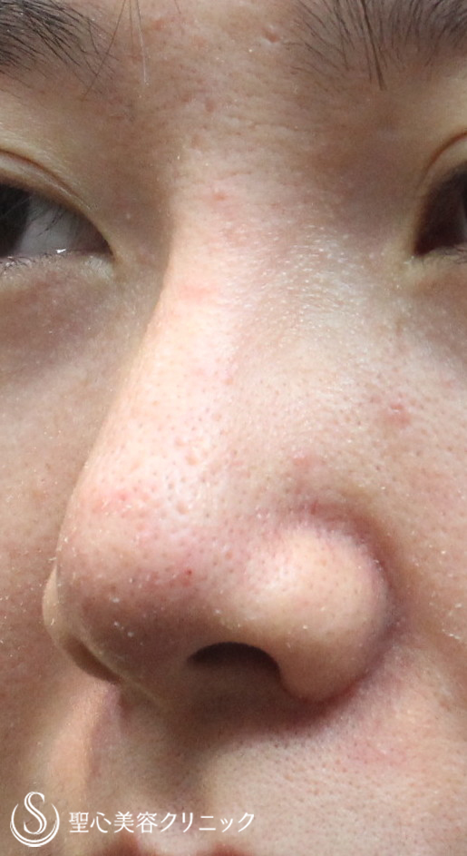 【20代女性・小鼻の広がりを小さく＋自然に鼻筋を通す】鼻プロテーゼ＋小鼻縮小（1ヶ月後） After 