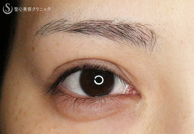 【20代女性・華やかな目元にする】二重全切開+α法＆目頭切開（6年後）→改良型目上切開修正（4年後） After 