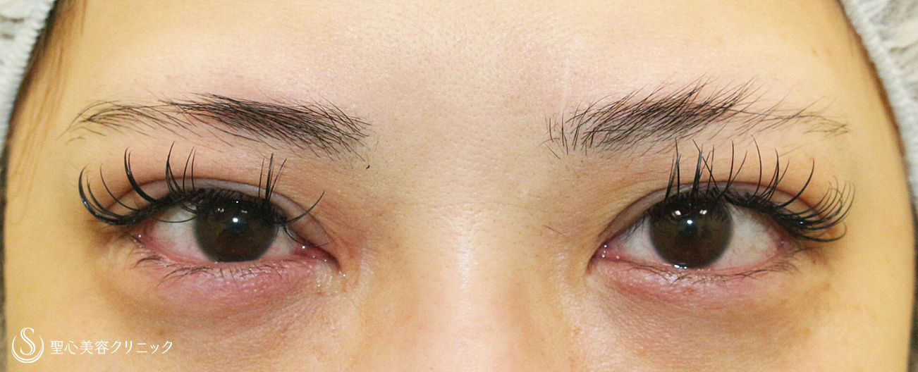 【30代女性・美容外科の二重＆眼瞼下垂】切らない眼瞼下垂+α＆マイクロメソッド+α（1年半後） Before 