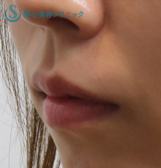 【20代女性・上唇が綺麗なM字型に、下唇はセクシーに】ヒアルロン酸+口角のボトックス注入（１ヶ月後） After 