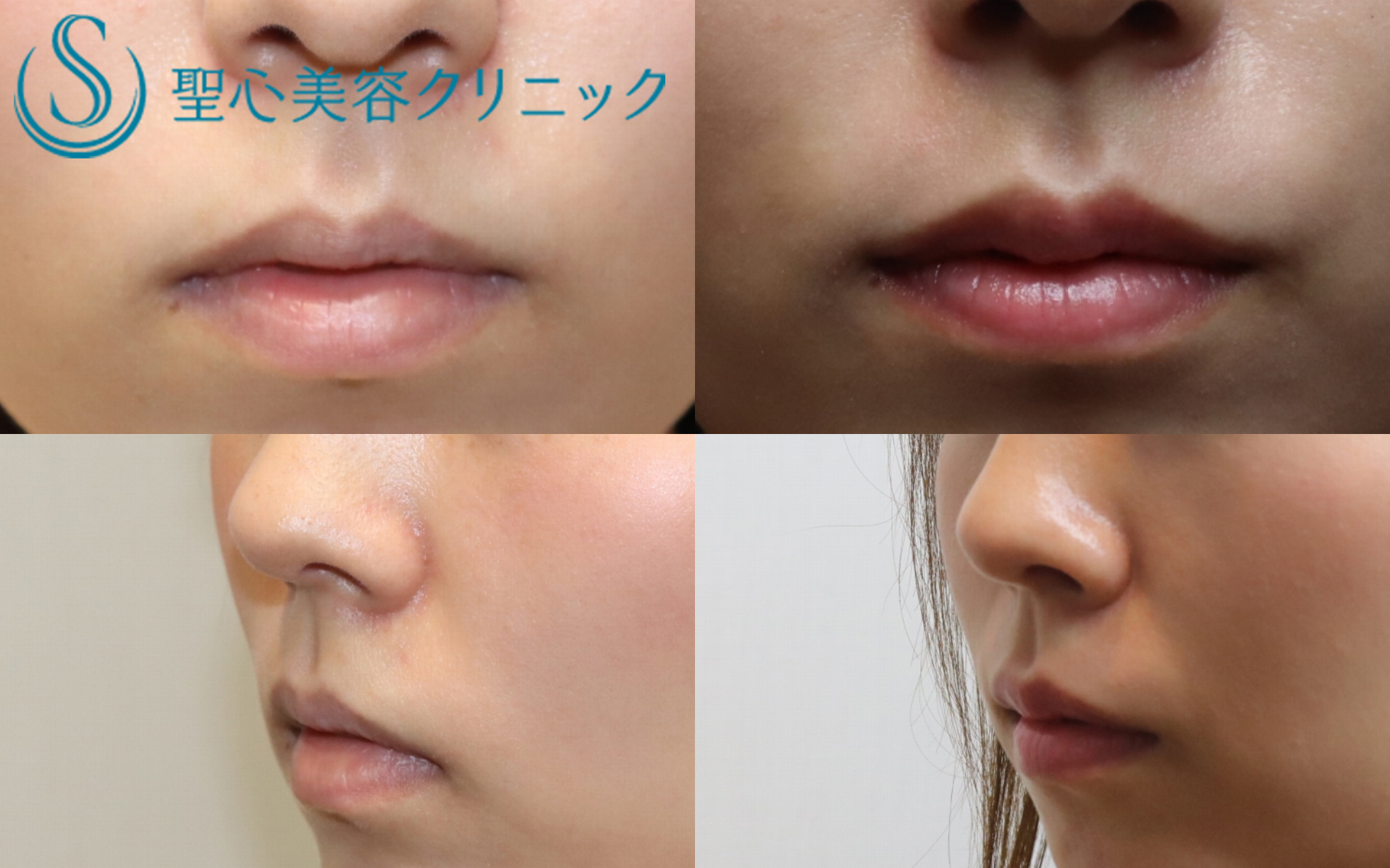 【20代女性・上唇が綺麗なM字型に、下唇はセクシーに】ヒアルロン酸+口角のボトックス注入（１ヶ月後） After 