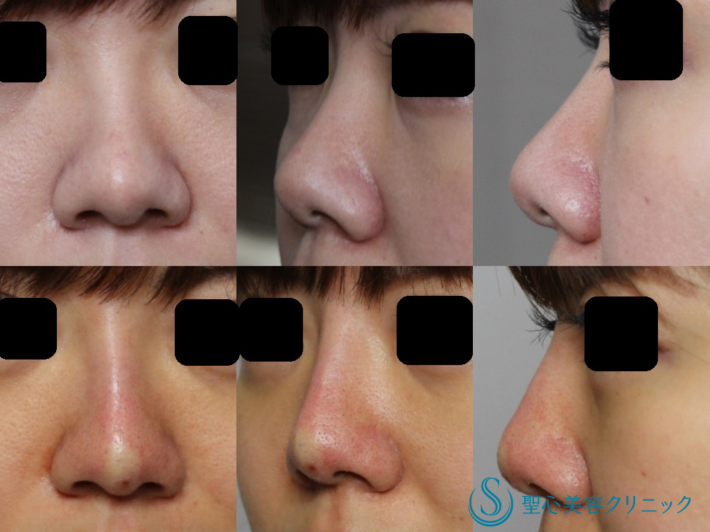 【20代女性・施術直後から綺麗な鼻筋に】鼻のクレヴィエル（1か月後）+Ｇ-mesh（直後） After 