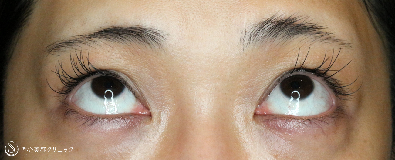 【30代女性・美容外科の二重＆眼瞼下垂】切らない眼瞼下垂+α＆マイクロメソッド+α（1年半後） Before 