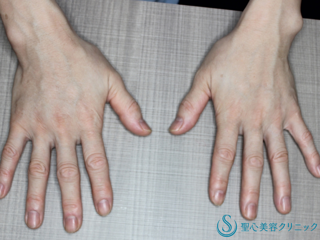 【50代女性・手の甲をふっくらと若々しく】プレミアムPRP 皮膚再生療法（１か月後） After 