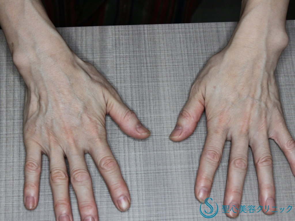 【50代女性・手の甲をふっくらと若々しく】プレミアムPRP 皮膚再生療法（１か月後） Before 
