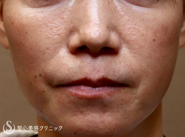 【女性・しわ、たるみ改善後２年経過】プレミアムPRP皮膚再生療法（２年後） After 