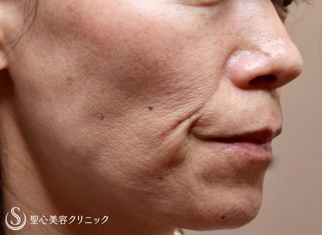 【女性・しわ、たるみ改善後２年経過】プレミアムPRP皮膚再生療法（２年後） Before 