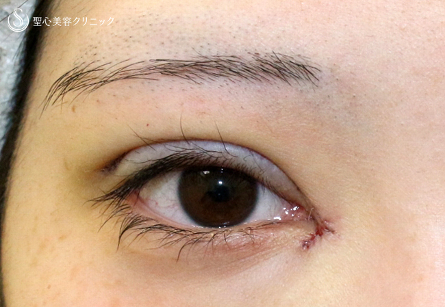 【20代女性・華やかな目元にする】二重全切開+α法＆目頭切開（6年後）→改良型目上切開修正（4年後） Before 
