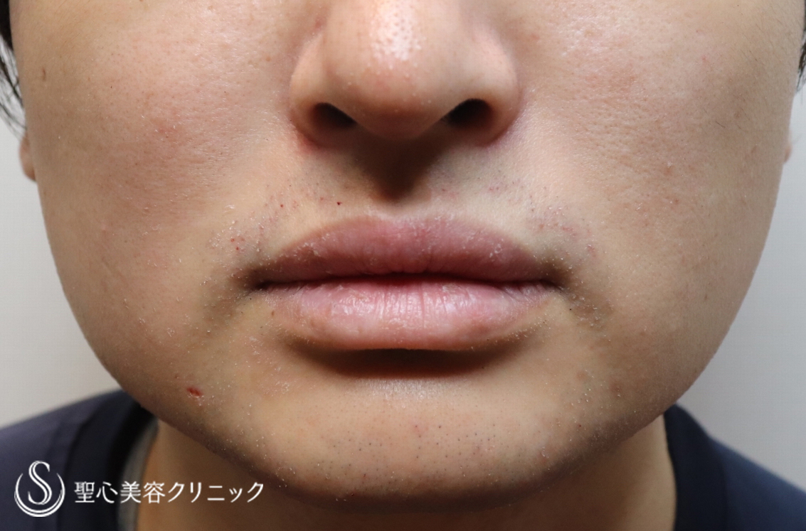 【20代男性・切らずに顎下と頬を細く】脂肪溶解注射2回（1ヶ月後） After 