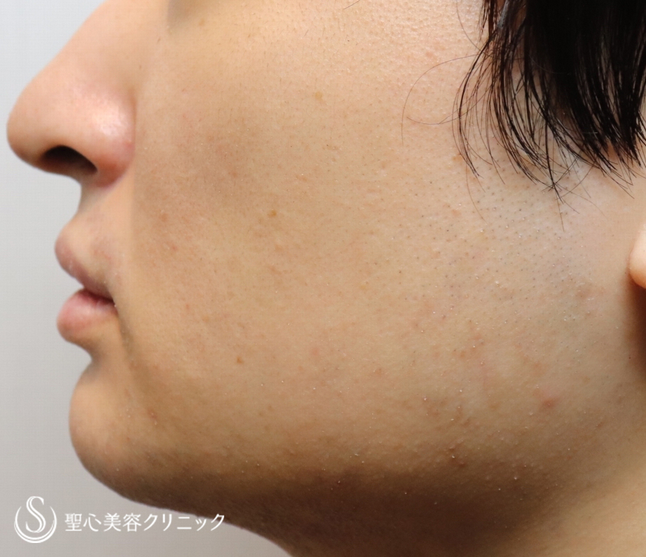 【20代男性・切らずに顎下と頬を細く】脂肪溶解注射2回（1ヶ月後） After 