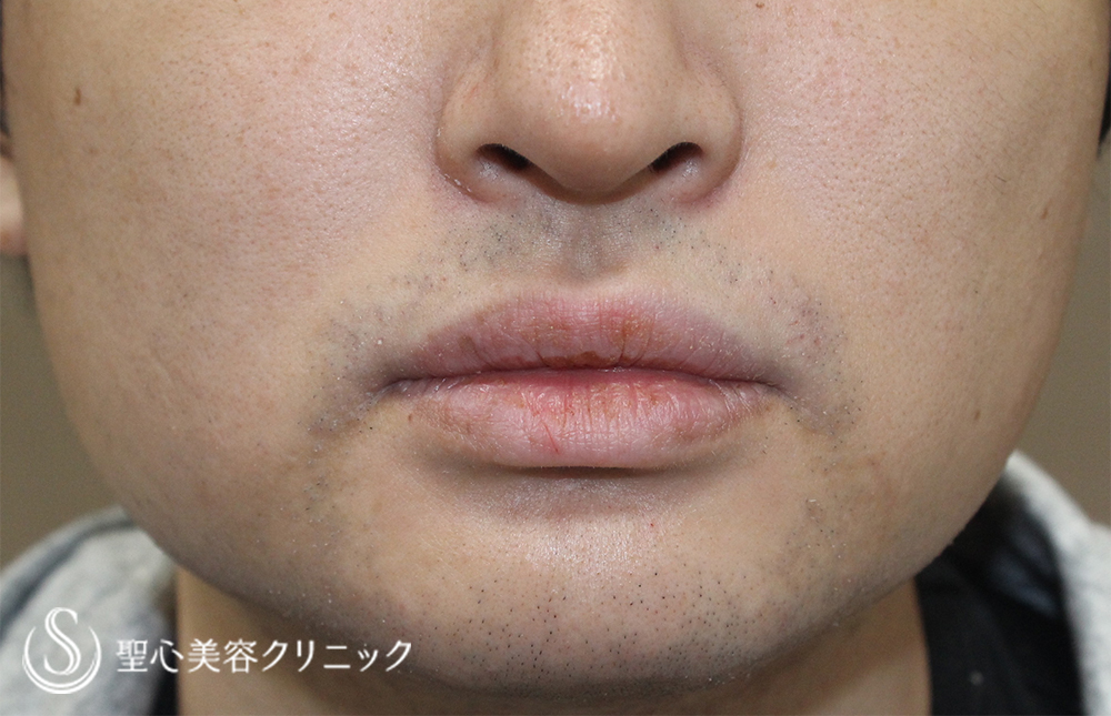 【20代男性・切らずに顎下と頬を細く】脂肪溶解注射2回（1ヶ月後） Before 