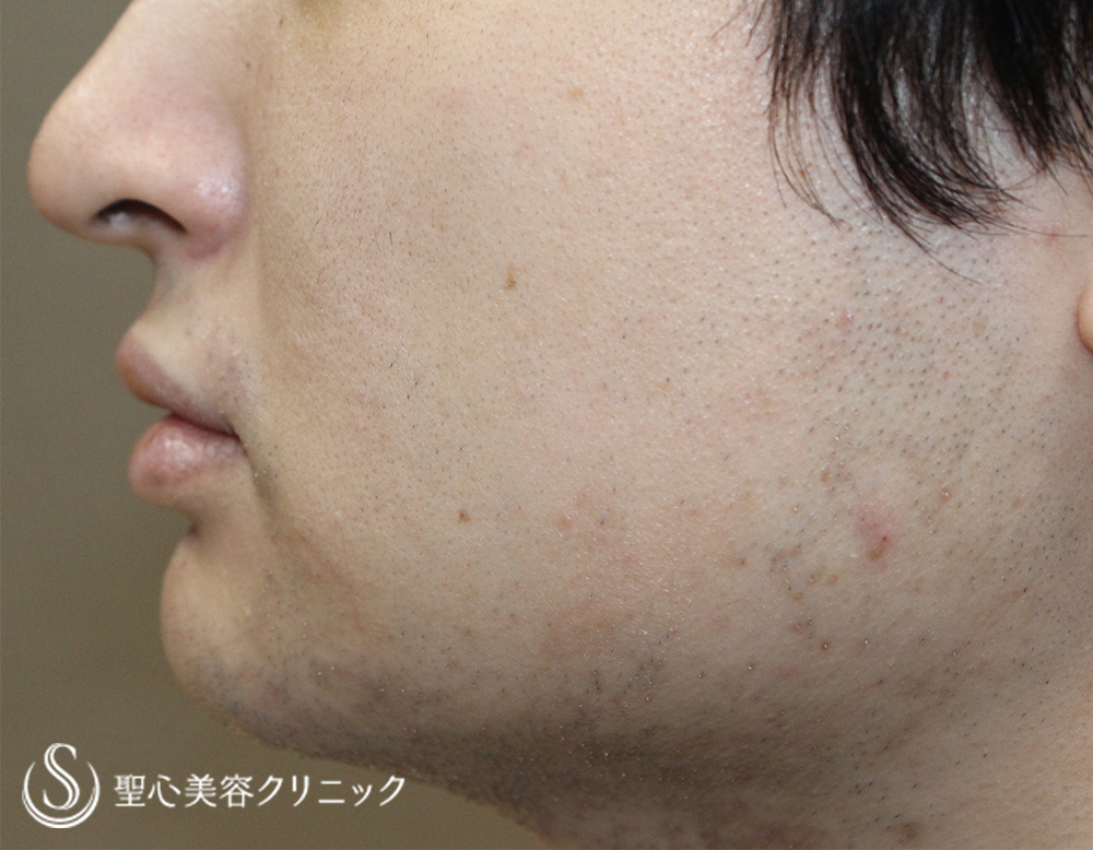 【20代男性・切らずに顎下と頬を細く】脂肪溶解注射2回（1ヶ月後） Before 
