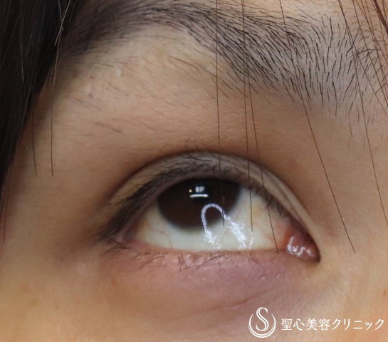 【30代男性・疲れた印象を改善】眼瞼下垂手術（埋没法）（１ヶ月後） After 