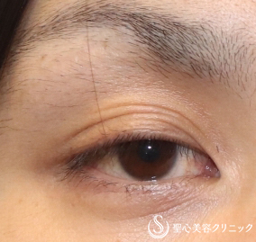 【30代男性・疲れた印象を改善】眼瞼下垂手術（埋没法）（１ヶ月後） Before 