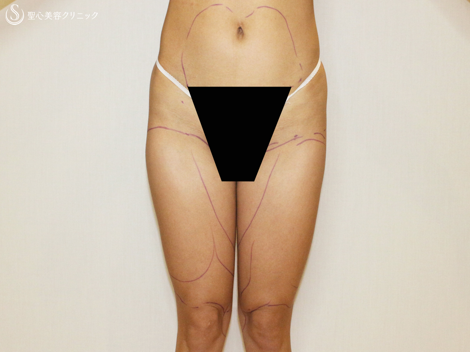 【30代女性・最新の脂肪幹細胞豊胸】プレミアムセリューション豊胸術（1年3ヶ月後） Before 
