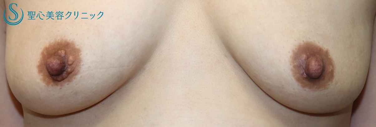 【40代女性・乳頭の下垂を修正し自然な大きさに】乳頭縮小術（1ヶ月後） After 