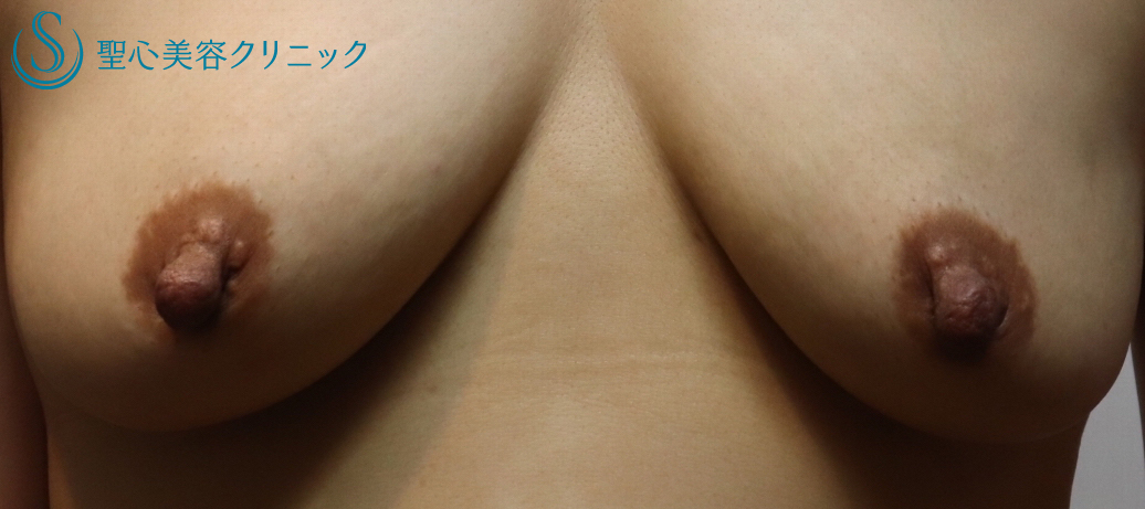 【40代女性・乳頭の下垂を修正し自然な大きさに】乳頭縮小術（1ヶ月後） Before 