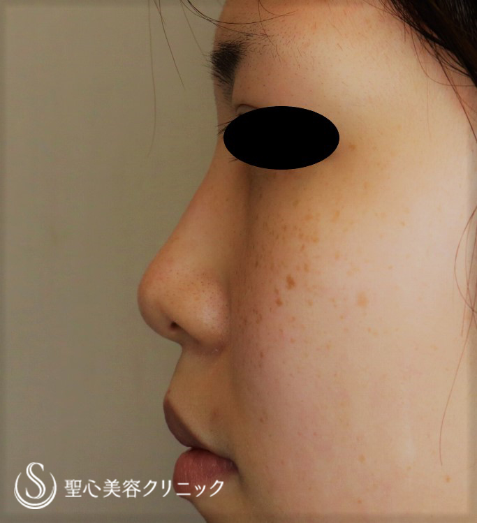 【20代女性・お鼻を高くスッキリ】プロテーゼ＋鼻尖縮小＋鼻尖形成（耳介軟骨移植）（1週間後） Before 