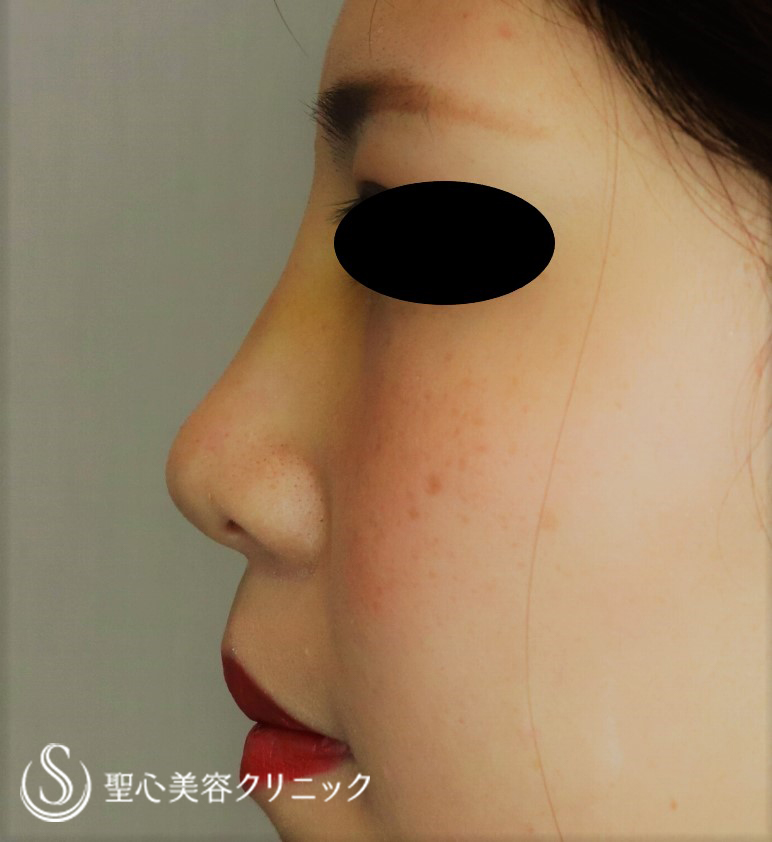 【20代女性・お鼻を高くスッキリ】プロテーゼ＋鼻尖縮小＋鼻尖形成（耳介軟骨移植）（1週間後） After 