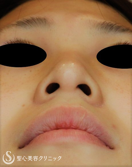 【20代女性・お鼻を高くスッキリ】プロテーゼ＋鼻尖縮小＋鼻尖形成（耳介軟骨移植）（1週間後） Before 