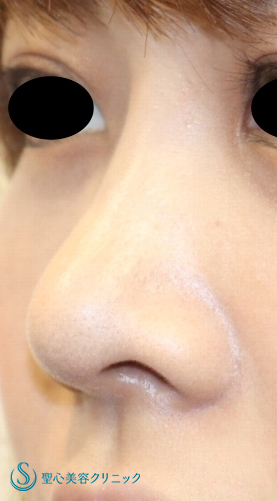 【20代女性・鼻先を細く、鼻筋を高く】鼻尖縮小＋耳介軟骨＋プロテーゼ（１週間後） After 