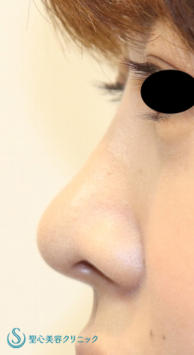 【20代女性・鼻先を細く、鼻筋を高く】鼻尖縮小＋耳介軟骨＋プロテーゼ（１週間後） After 