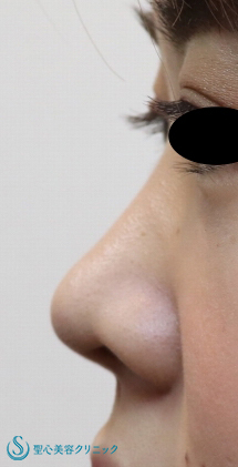 【20代女性・鼻先を細く、鼻筋を高く】鼻尖縮小＋耳介軟骨＋プロテーゼ（１週間後） Before 