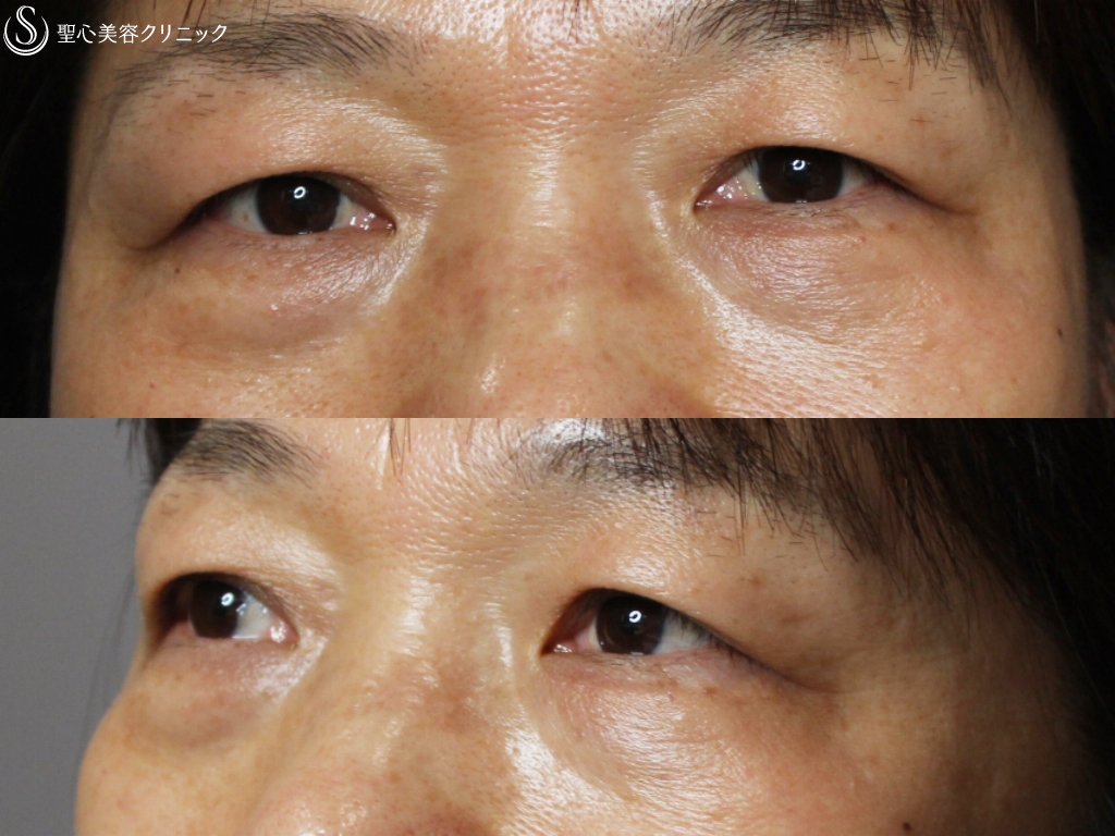 【50代女性】眉下切開、目の下結膜側脱脂+プレミアムPRP皮膚再生療法（3ヶ月後） Before 