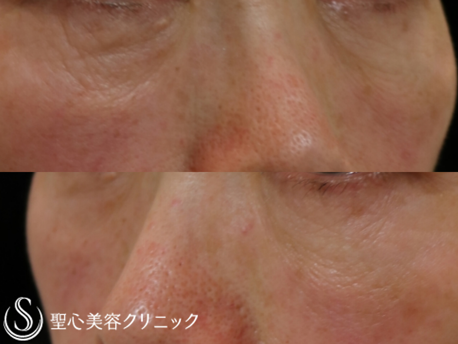 【60代女性・目の下の凹みを改善】プレミアムPRP皮膚再生療法（6年後） After 