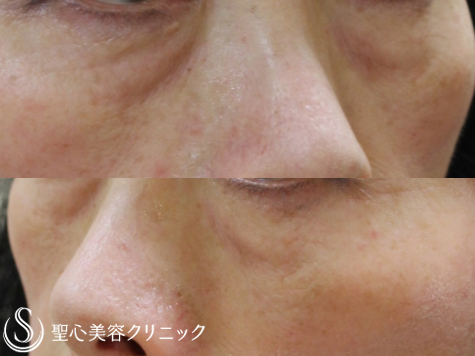 【60代女性・目の下の凹みを改善】プレミアムPRP皮膚再生療法（6年後） Before 