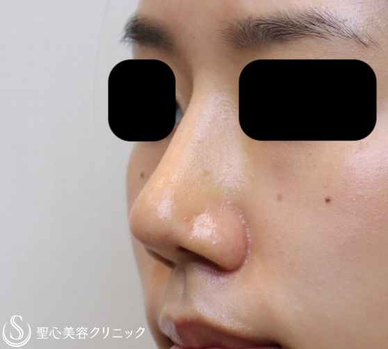 【20代女性・他院修正で美人鼻に】鼻プロテーゼ+鼻尖縮小+耳介軟骨移植（1ヶ月後） After 