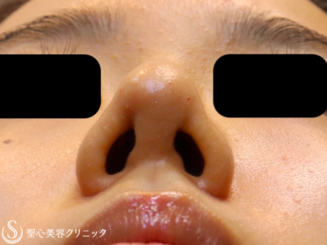【20代女性・他院修正で美人鼻に】鼻プロテーゼ+鼻尖縮小+耳介軟骨移植（1ヶ月後） After 