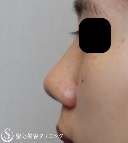 【20代女性・他院修正で美人鼻に】鼻プロテーゼ+鼻尖縮小+耳介軟骨移植（1ヶ月後） Before 