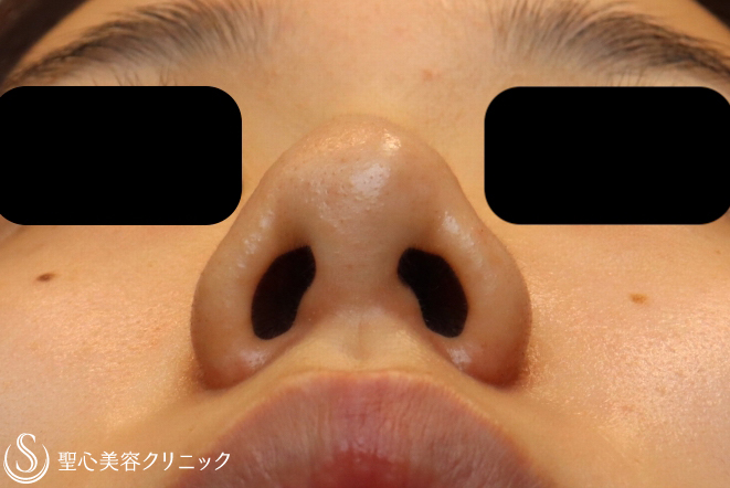 【20代女性・他院修正で美人鼻に】鼻プロテーゼ+鼻尖縮小+耳介軟骨移植（1ヶ月後） Before 
