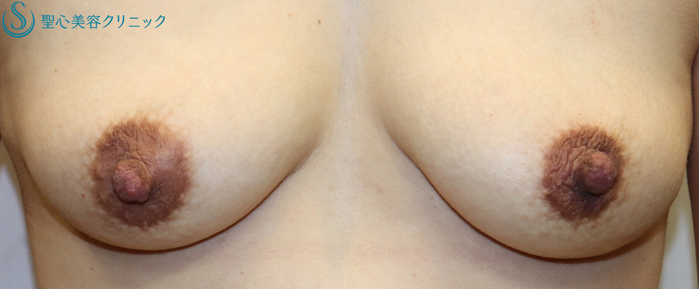 【30代女性・乳頭の大きさを修正】乳頭縮小術（1ヶ月後） Before 